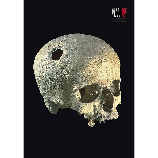 Crâne néolithique avec trépanation curative