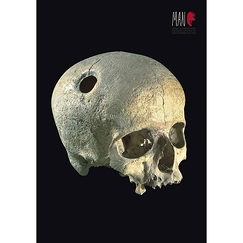 Carte postale "Crâne néolithique avec trépanation curative"